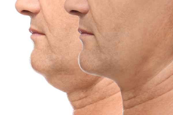 HIFU - Breakthrough in Anti - ageing 2 hifu results Loughborough