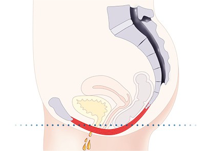 Pelvic-Floor Muscle Repair 5 Pelvic floor muscles Loughborough