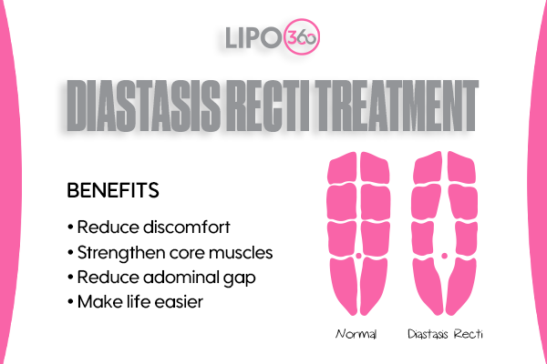 Revolutionising Muscle Repair: The Power of LIPO360 Body Sculpt Post-Injury 5 diastasis recti treatment Loughborough