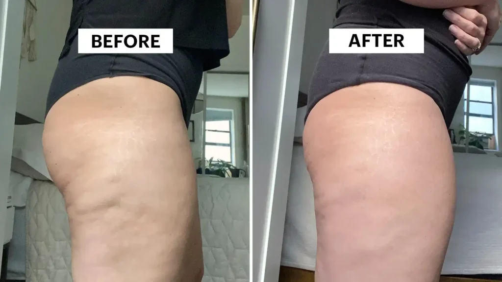 Sculpting Your Bum: Can Toning Exercises Really Reduce Cellulite? 1 Do Toning Exercise Loughborough Really Tackle Cellulite?