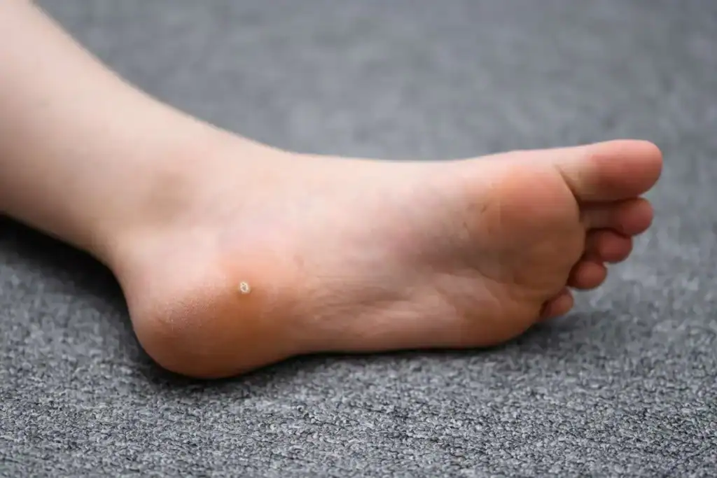 Cryotherapy For Warts And Also Verrucas 2 Image of verruca on the bottom of the foot that able to be treated with Cryotherapy Loughborough
