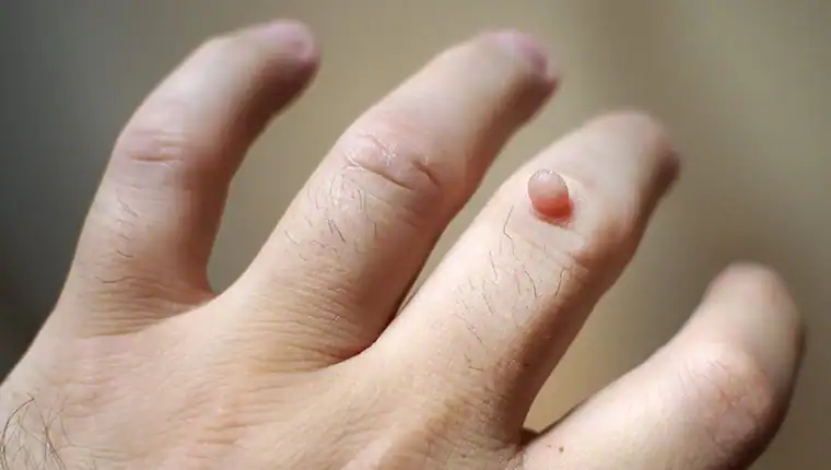 Image of blemish that Cryotherapy Loughborough can remove with Lipo 360.