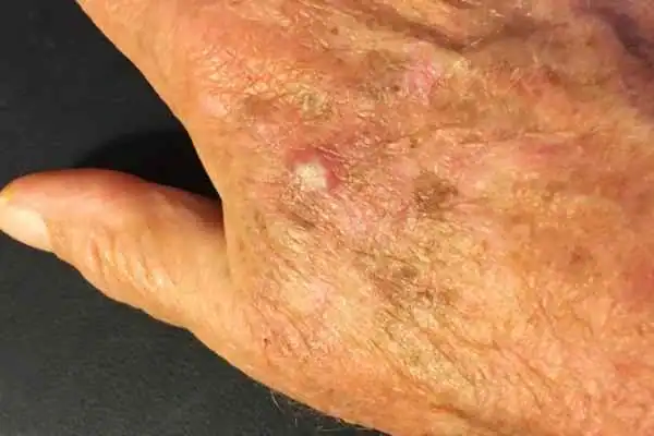 Cryopen For Actinic Keratoses 1 Image of Actinic keratoses Loughborough on a person hand