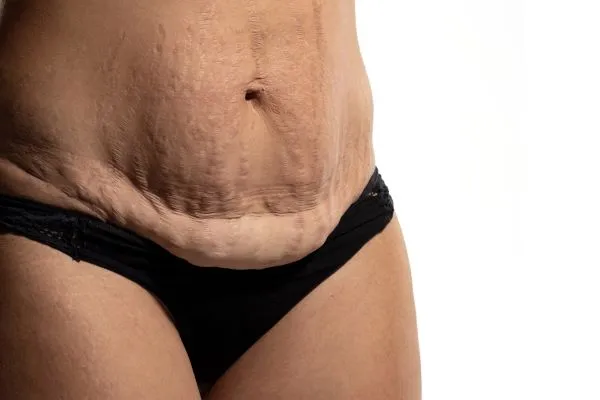 The science behind skin tightening Loughborough picture of a woman's sagging skin on the stomach